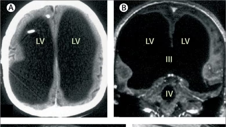 Man who is missing 90% of his brain leads a normal life