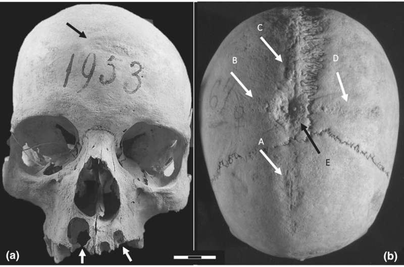 Volunteering for cranial surgery in medieval Italy